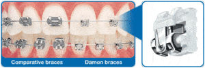 Side by side comparison of smaller Damon brackets compared to other braces