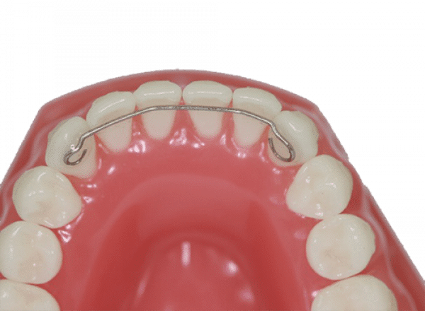 Photo of a model of bottom teeth with a fixed retainer.
