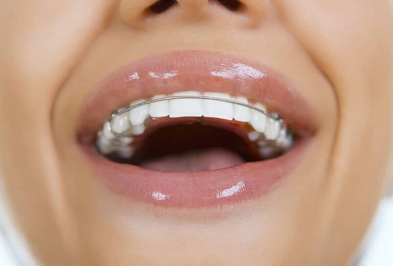Close up of a woman smiling with a Hawley retainer.