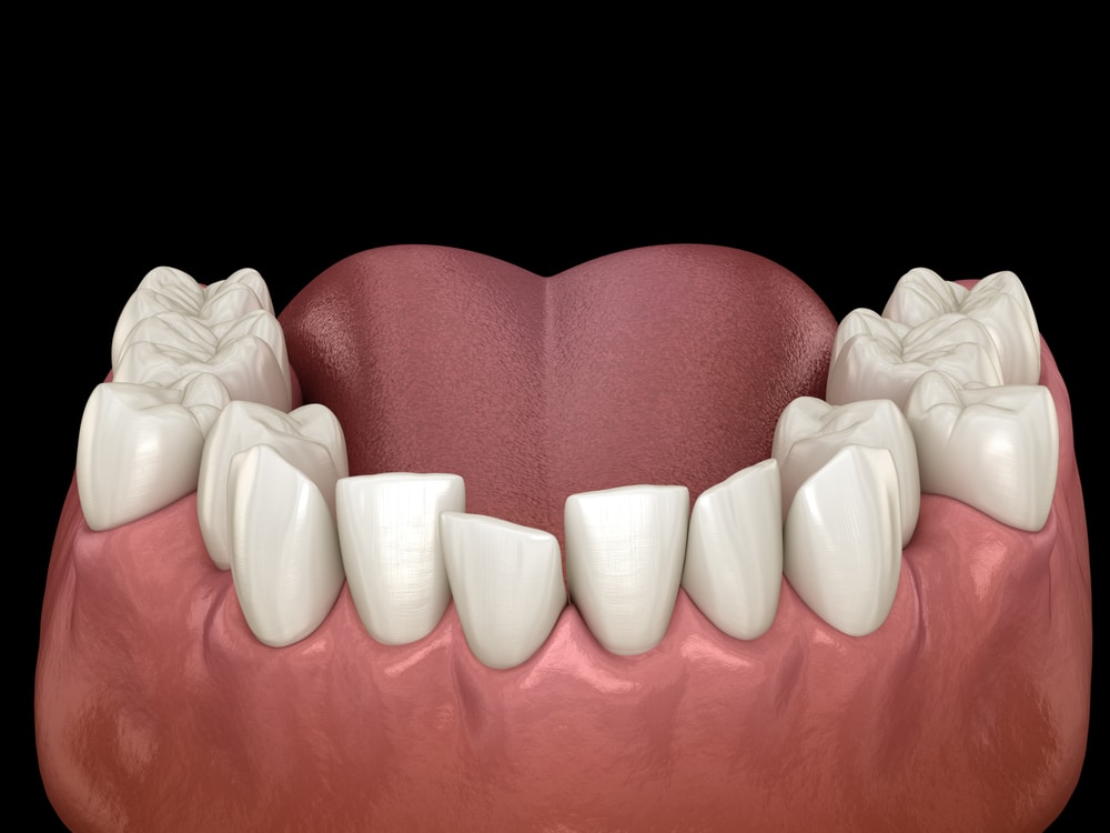 3d model of crooked bottom teeth.