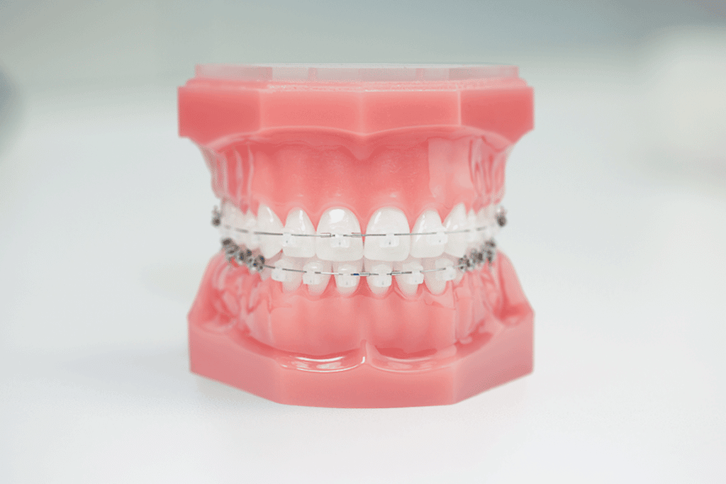 a typodont model wearing damon clear braces