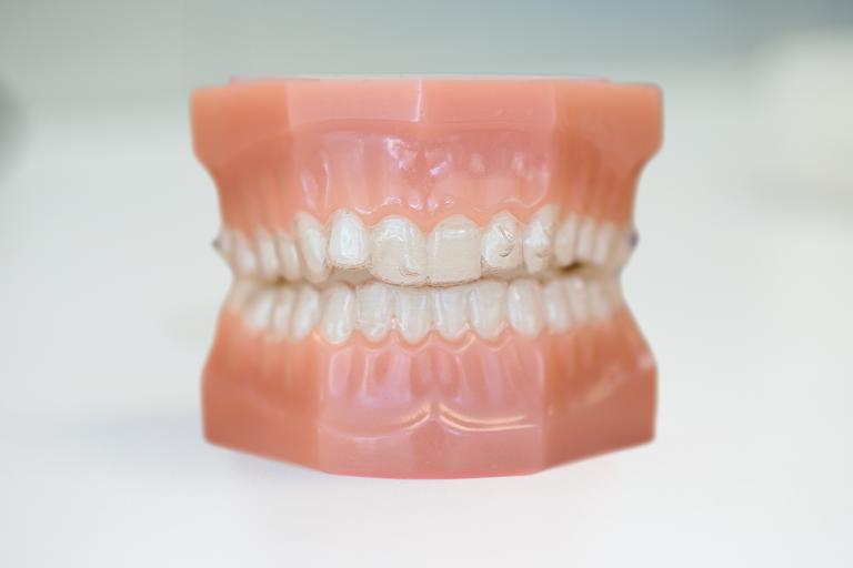 a typodont model with invisalign clear aligners