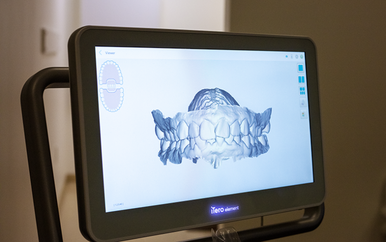 the itero element machine showing a patient's 3d scans of their teeth