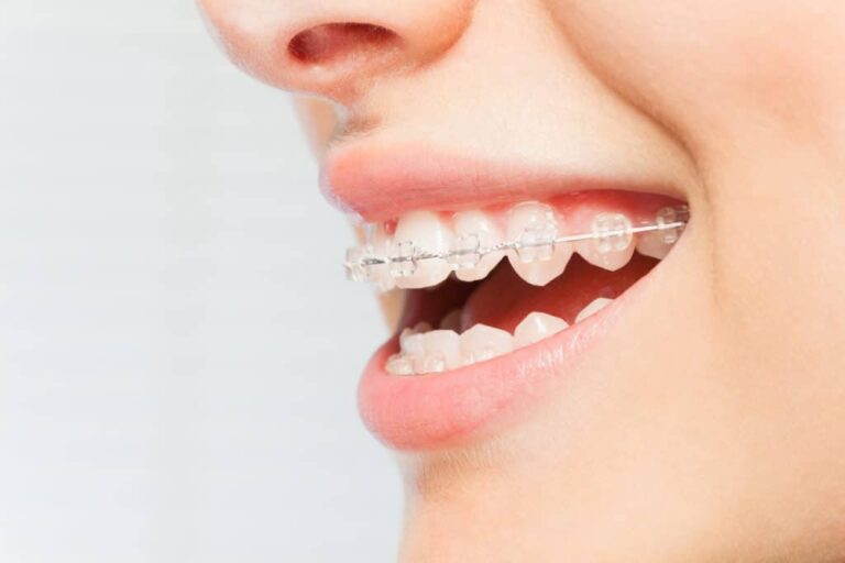 up close of a womans mouth wearing ceramic braces