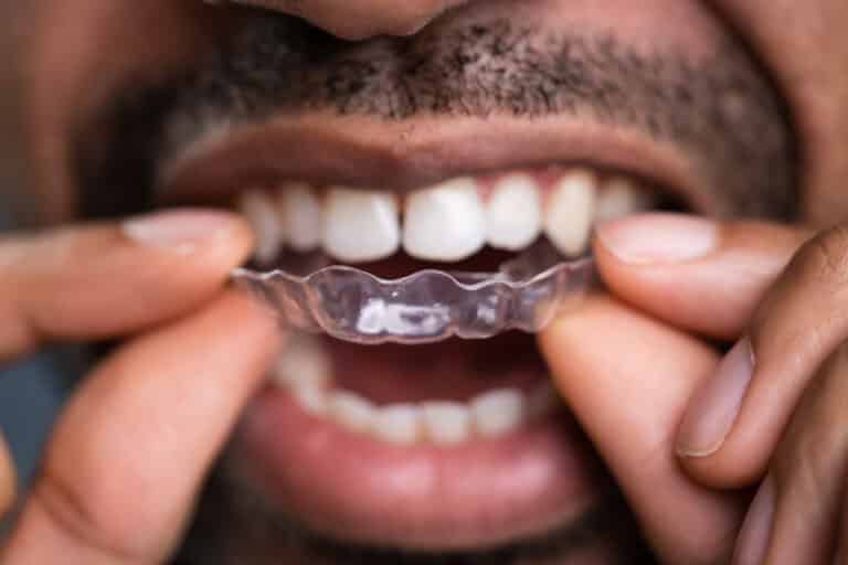 a man with a beard and mustash inserting invisalign clear aligners