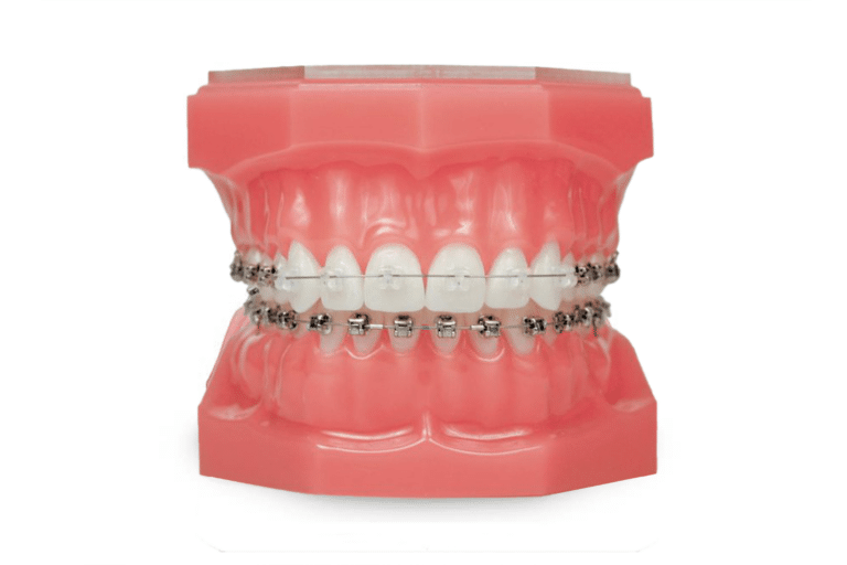 Dental model with a combination of metal and clear damon braces