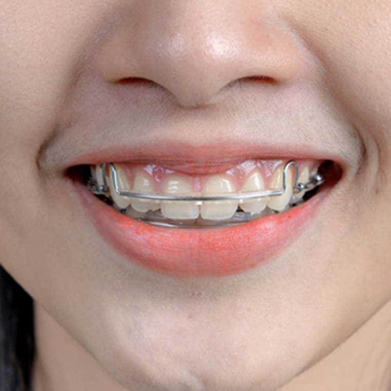 Close up of the smile of a teen with a hawley retainers in Wake Forest