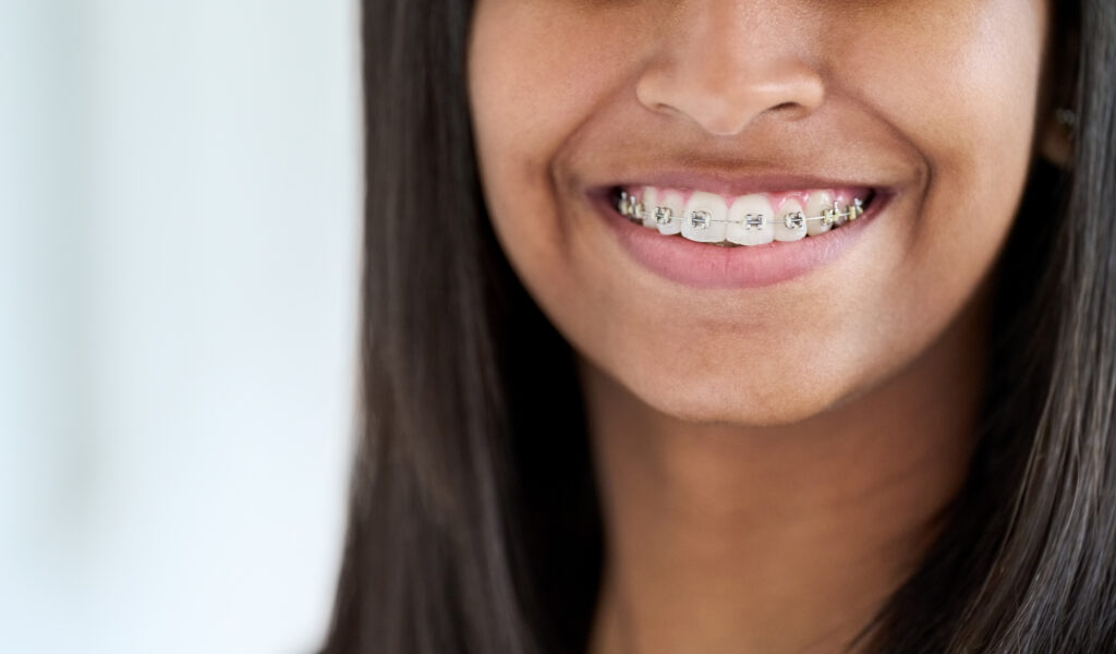 Close up of a smiling girl with metal braces