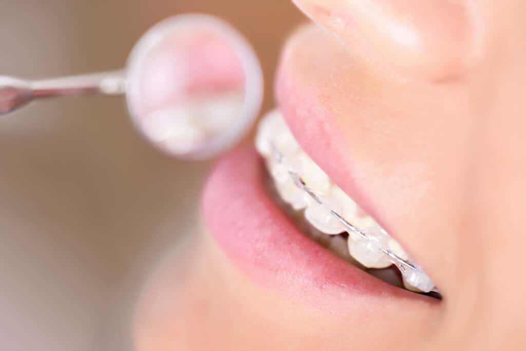 Woman with Damon Clear Braces in Clayton, NC having her braces examined by her orthodontist