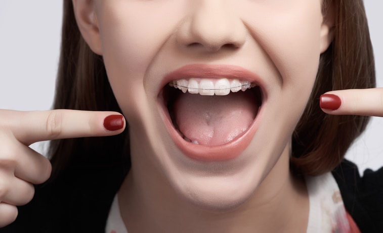 front view of woman with mouth open wearing braces and pointing on it.