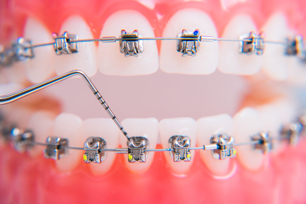 On Macro Photos Shows How The System Of Brackets Is Arranged