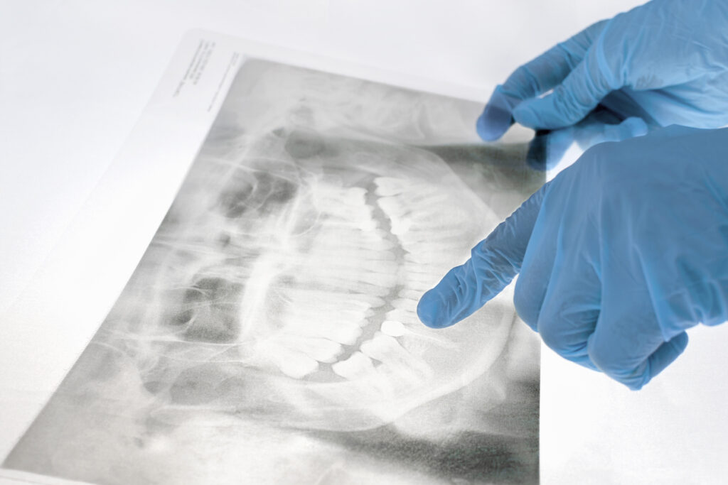 Close Up Of A Dentists Hand In Medical Gloves Holding A Panoramic X Ray Of The Teeth And Jaw In Front Of A Light Box In The Dental Office And Pointing A Finger At A Bad Tooth. Stomatology Pantomogram