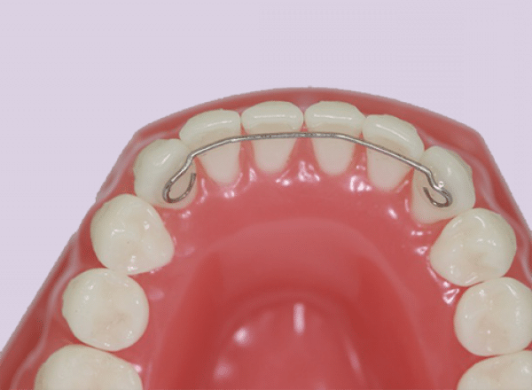 Photo of a model of bottom teeth with a fixed retainer.
